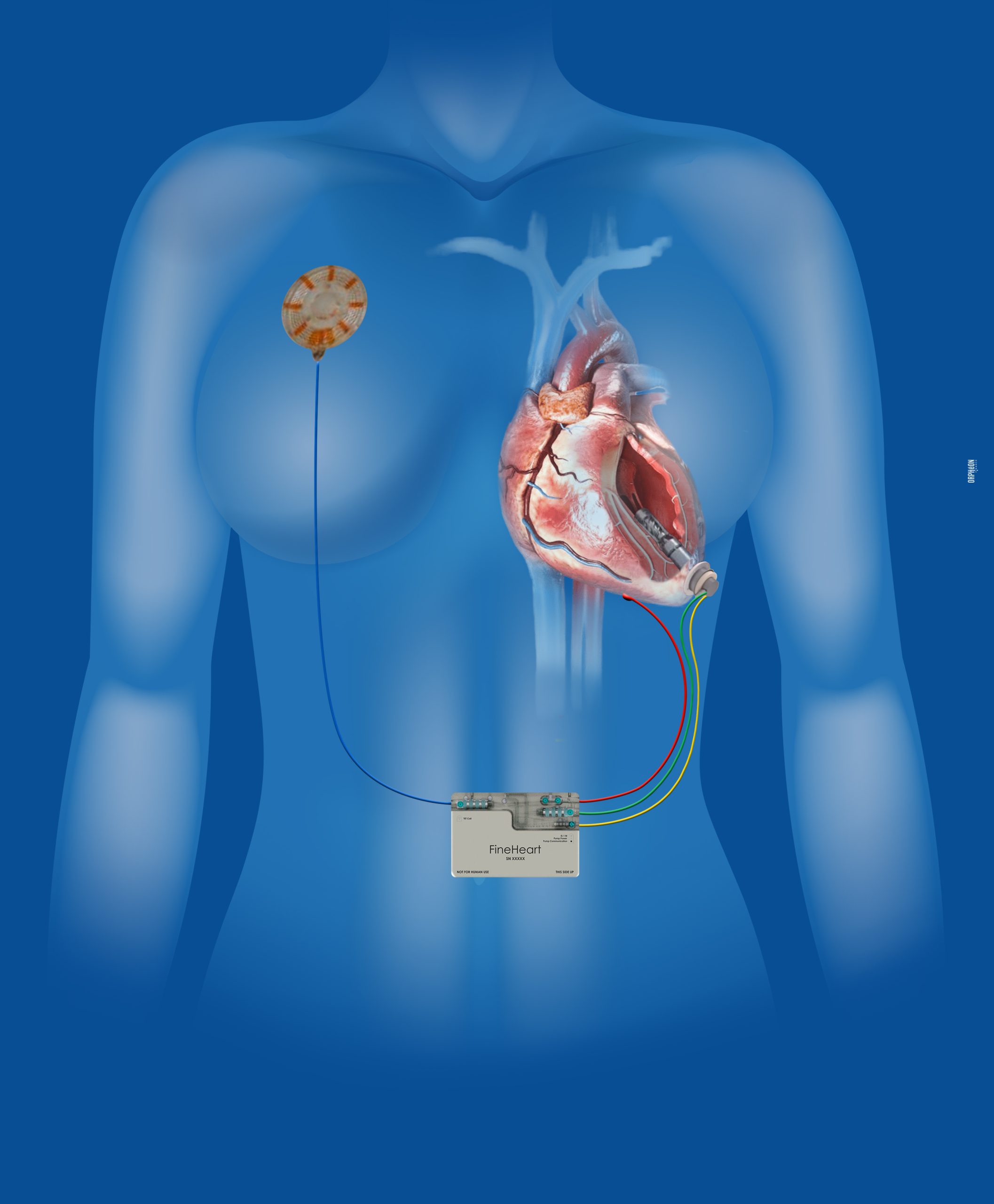 FlowMaker®, FineHeart, Arnaud Mascarell